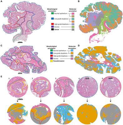 Recognition of pseudoinvasion in colorectal adenoma using spatial glycomics